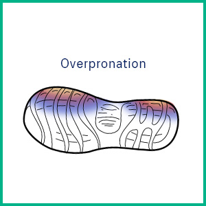 Overpronation