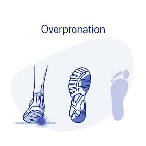 Overpronation